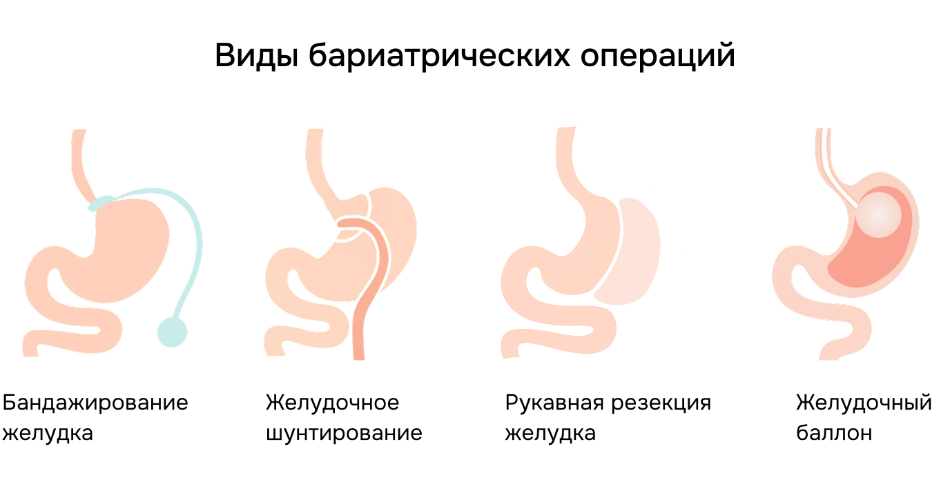Виды бариатрических операций