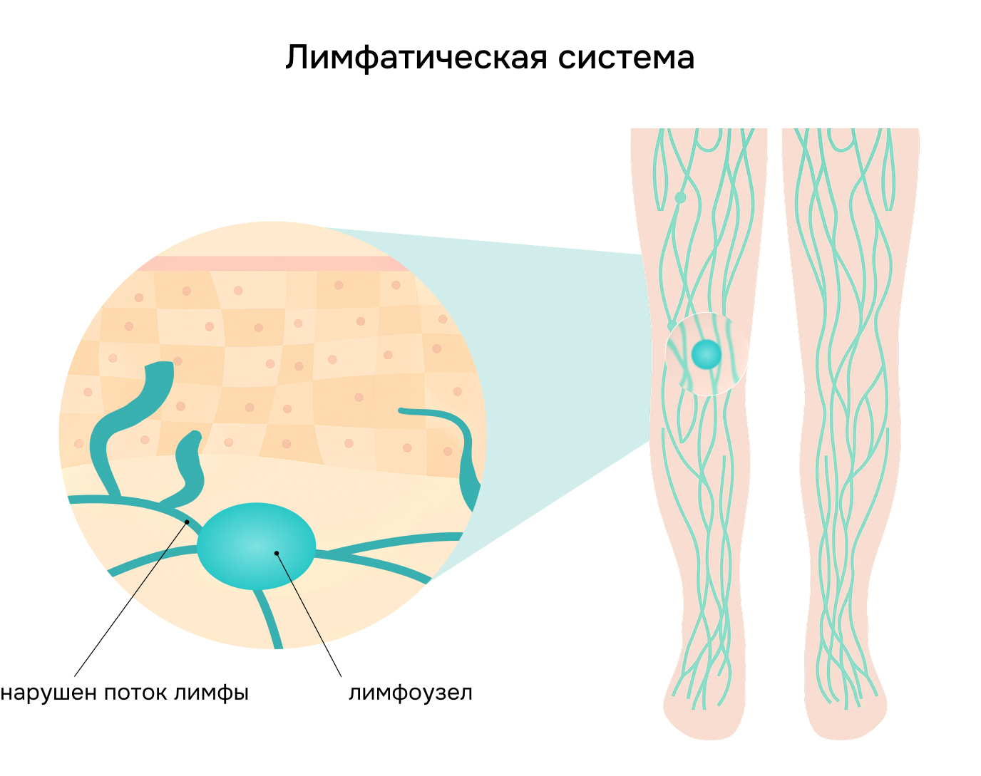 Лимфатическая система; нарушен поток лимфы; лимфоузел